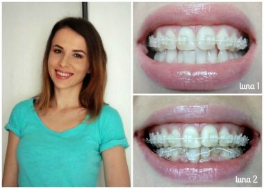 De ce sa iti pui un aparat dentar din safir?