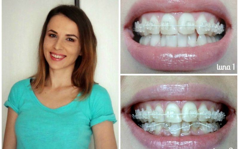 De ce sa iti pui un aparat dentar din safir?