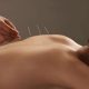 Ce este acupunctura si cum te ajuta ea?