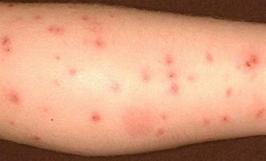 Plosnitele si muscaturile de plosnita: sase solutii ieftine si naturale pentru a trata muscaturile si senzatia de mancarime