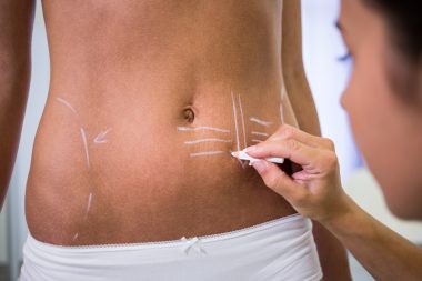 Cum functioneaza lipoaspiratia