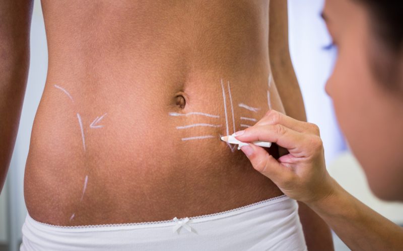 Cum functioneaza lipoaspiratia